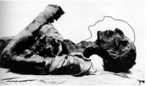 Figure 2. The Remains of Pharaoh Ramses II, Indicating the Pre-Mortem Position of the Neck and the Forced Hyperextension of the Cervical Spine to Fit into the Sarcophagus
