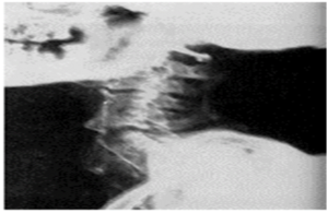 Figure 3. Lateral Spinal Radiograph of Ramses II: The Results of Forced Hyperextension of a Fused Cervical Spine