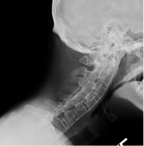Figure 1. Lateral Cervical Spine Radiograph of a Patient with Advanced AS. Note the Fusion of the Apophyseal Joints Posteriorly and of the Outer Fibers of the Annulus Fibrosus Anteriorly